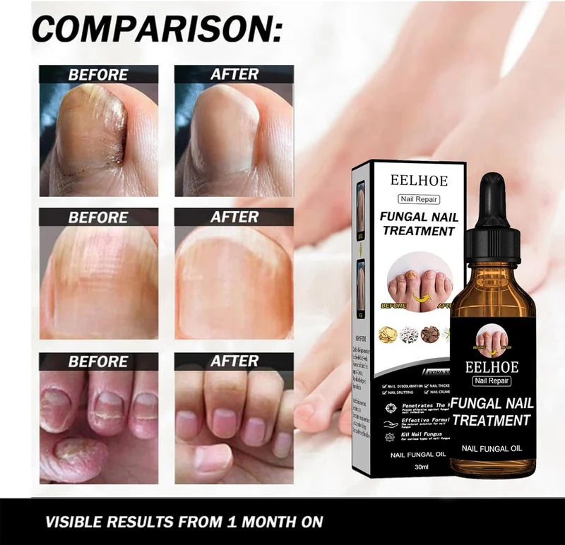 EELHOE Fungal Nail Treatment Oil